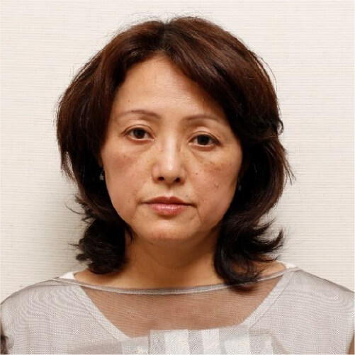 施術回数1回　50代　Aさん BEFORE